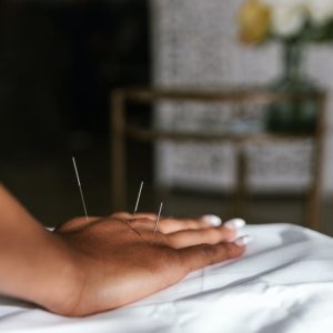 acupuncture hand